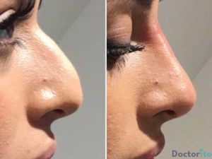 نمونه عمل بینی قوز دار2
