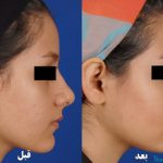 نمونه عمل بینی دکتر رضا افراه2