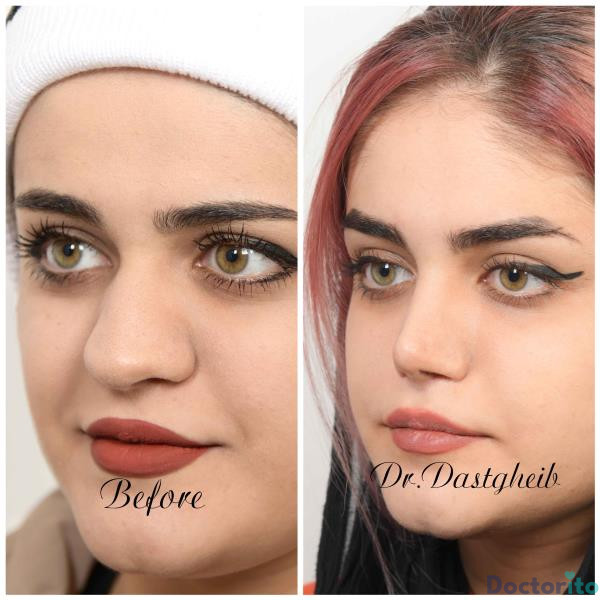نمونه عمل بینی دکتر سید حسین دستغیب 3