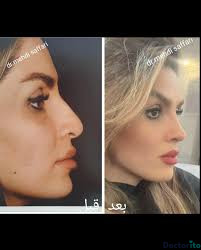نمونه عمل بینی دکتر مهدی صفاری طاهری