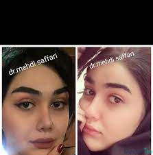 نمونه عمل بینی دکتر مهدی صفاری طاهری1