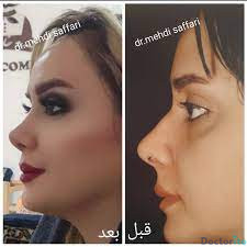 نمونه عمل بینی دکتر مهدی صفاری طاهری2
