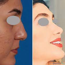 نمونه عمل بینی دکتر محسن روشنی