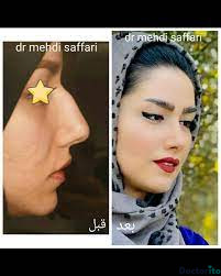 نمونه عمل بینی دکتر مهدی صفاری طاهری3
