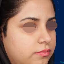 نمونه عمل بینی دکتر محسن روشنی6