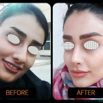 نمونه عمل بینی نیمه فانتزی دکتر آرش سبحان منش