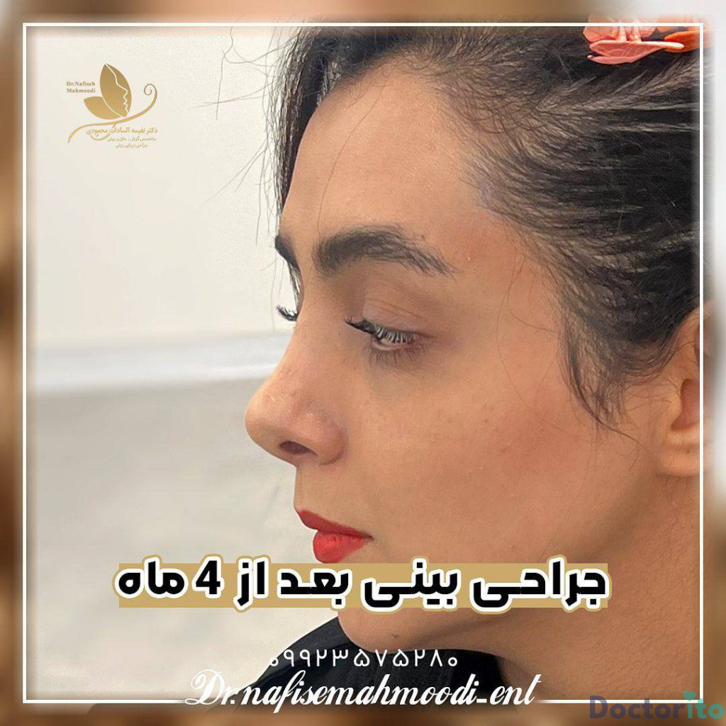 نمونه عمل بینی دکتر نفیسه السادات محمودی2