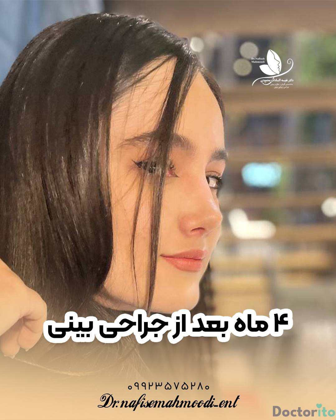 نمونه عمل بینی دکتر نفیسه السادات محمودی3