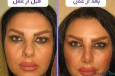 نمونه عمل بینی دکتر اصغر معمارزاده (1)