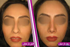 نمونه عمل بینی دکتر اصغر معمارزاده (3)