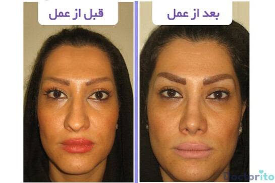 نمونه عمل بینی دکتر اصغر معمارزاده (4)