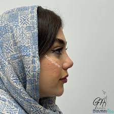 نمونه عمل بینی دکتر امین قانعی 3