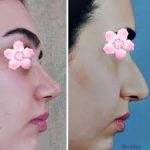 نمونه عمل بینی دکتر سعید فلاحتی (3)