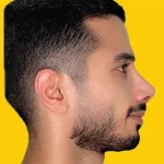 نمونه عمل بینی دکتر سید محمد طالب زاده (2)
