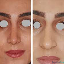 نمونه عمل بینی دکتر شهریار لقمانی (2)