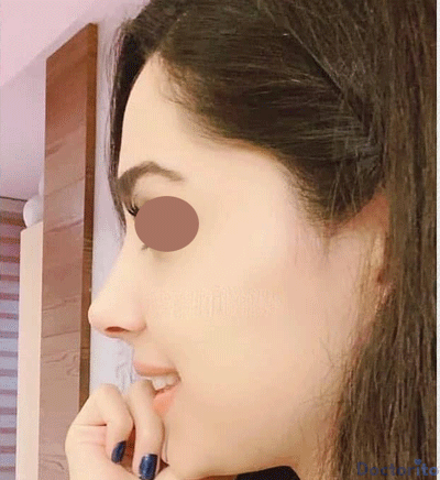نمونه عمل بینی دکتر شهریار لقمانی4