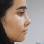 نمونه عمل بینی دکتر شیرین گل محمدی (1)