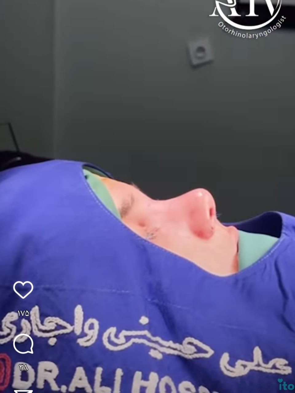نمونه عمل بینی دکتر علی حسین واجاری (1)