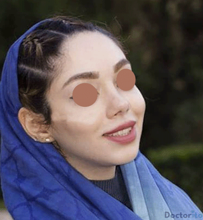 نمونه عمل بینی دکتر علیرضا پورصیرفی (1)