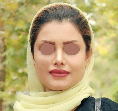 نمونه عمل بینی دکتر علیرضا پورصیرفی (3)