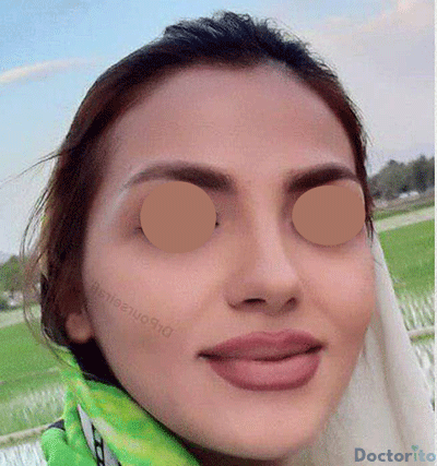 نمونه عمل بینی دکتر علیرضا پورصیرفی (4)