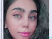 نمونه عمل بینی دکتر غلامرضا معین (5)