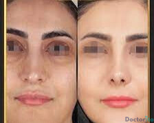 نمونه عمل بینی دکتر محسن روشنی (1)