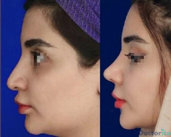 نمونه عمل بینی دکتر محسن روشنی (2)