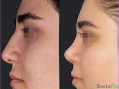 نمونه عمل بینی دکتر محسن روشنی (3)