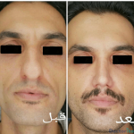 نمونه عمل بینی دکتر مسلم واحدی پور
