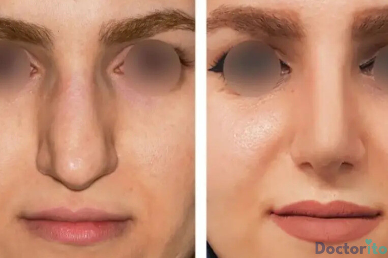 نمونه عمل بینی دکتر کامران بابائی 3