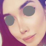 نمونه عمل بینی نیمه فانتزی دکتر ونون آصفی (2)