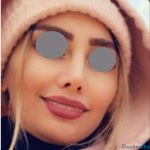 نمونه عمل بینی نیمه فانتزی دکتر ونون آصفی (3)