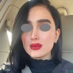 نمونه عمل بینی نیمه فانتزی دکتر ونون آصفی (4)