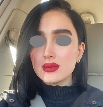 نمونه عمل بینی نیمه فانتزی دکتر ونون آصفی (4)