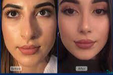 نمونه عمل بینی دکتر امین نوروزی (3)