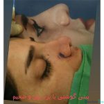 نمونه عمل بینی دکتر سید محمد کاظم رشته احمدی (3)
